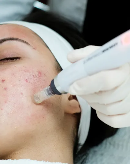 Advanced Acne Treatment