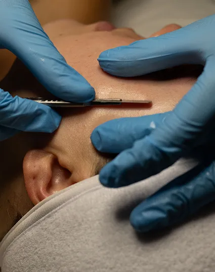 Dermaplaning