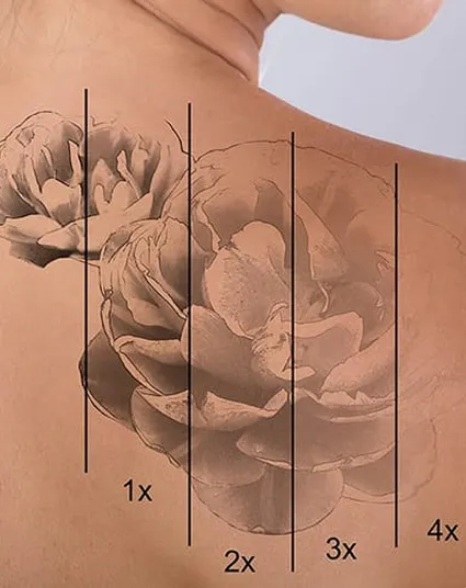 Tattoo Removal
